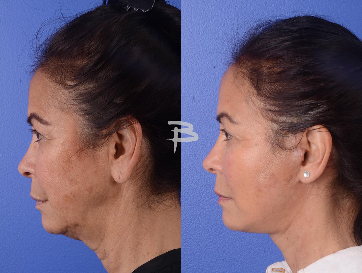 Facelift Before & After Gallery - Patient 423203 - Image 3