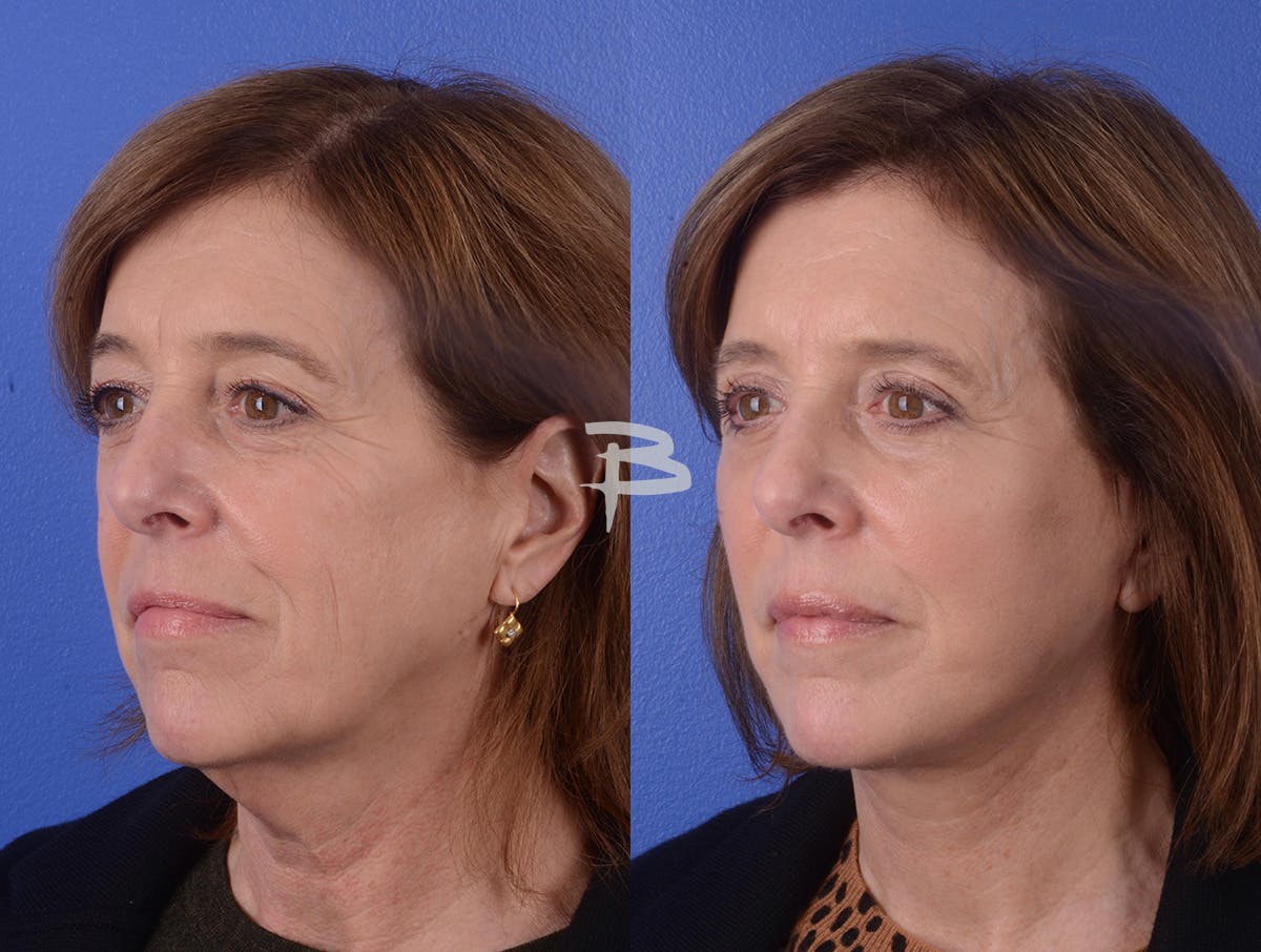 Facelift Before & After Gallery - Patient 207631 - Image 2