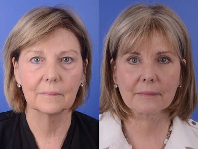 Facelift Before & After Gallery - Patient 197646 - Image 1