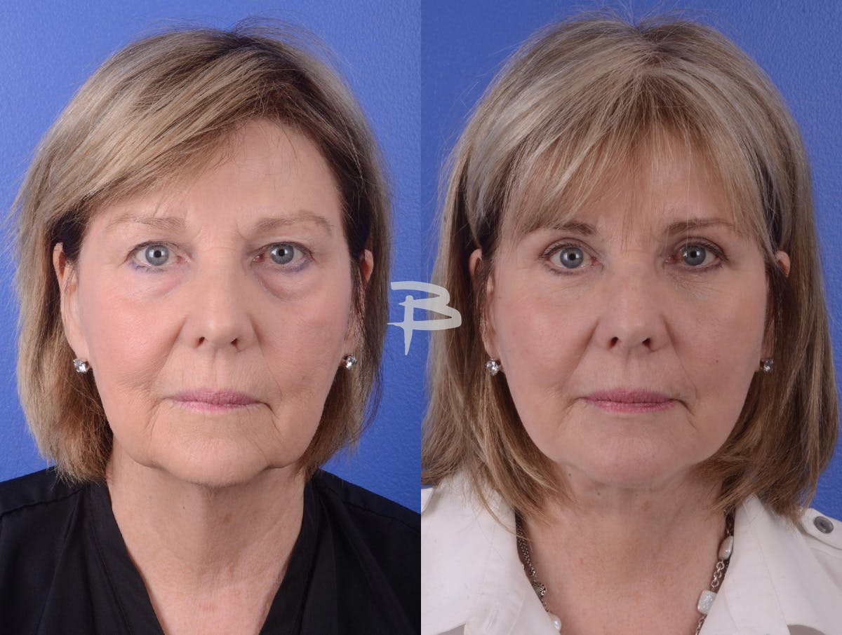 Facelift Before & After Gallery - Patient 197646 - Image 1