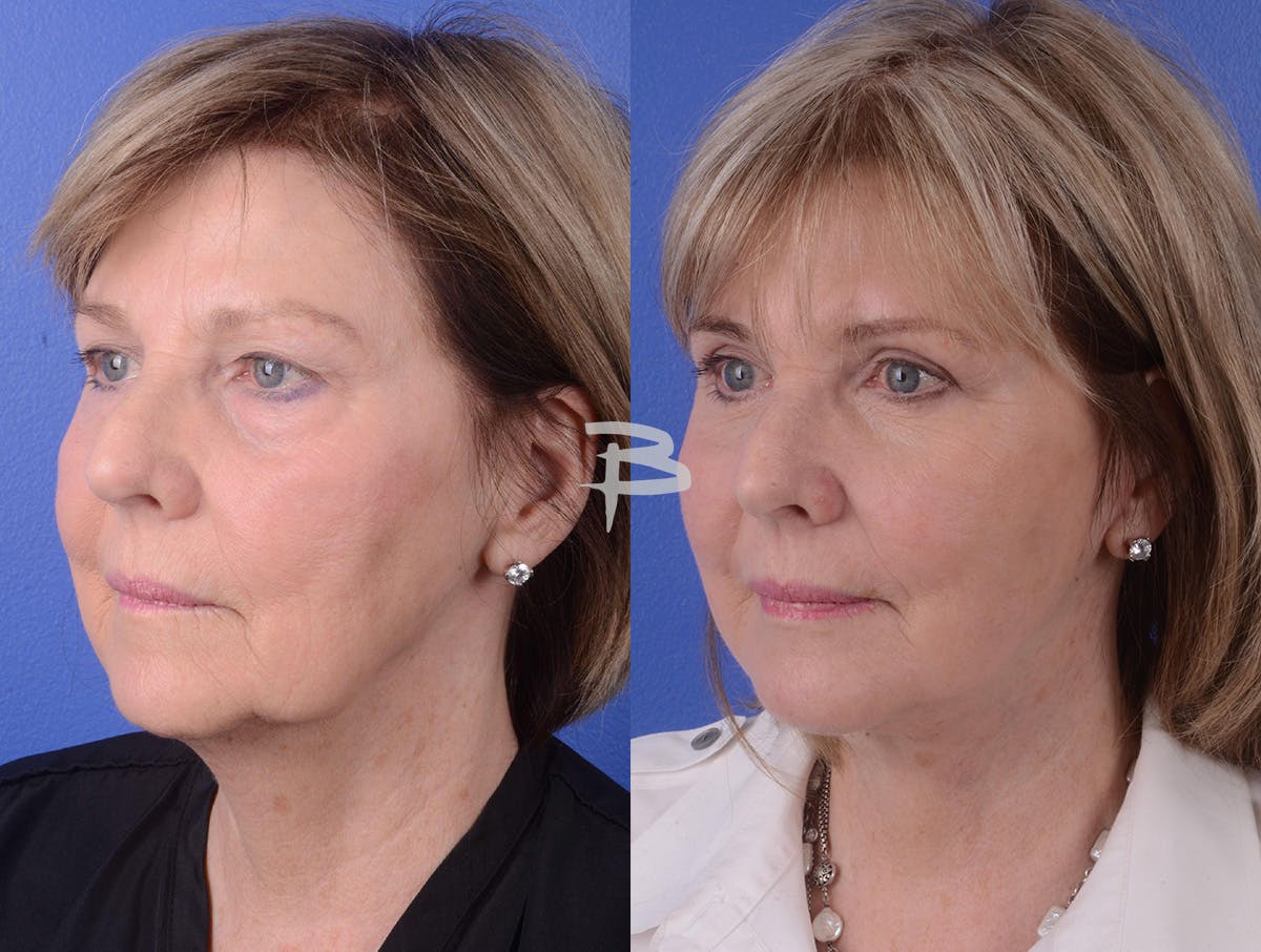 Facelift Before & After Gallery - Patient 197646 - Image 2