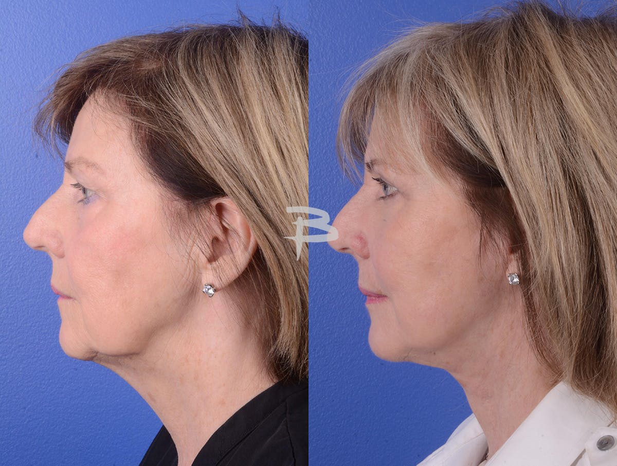 Facelift Before & After Gallery - Patient 197646 - Image 3