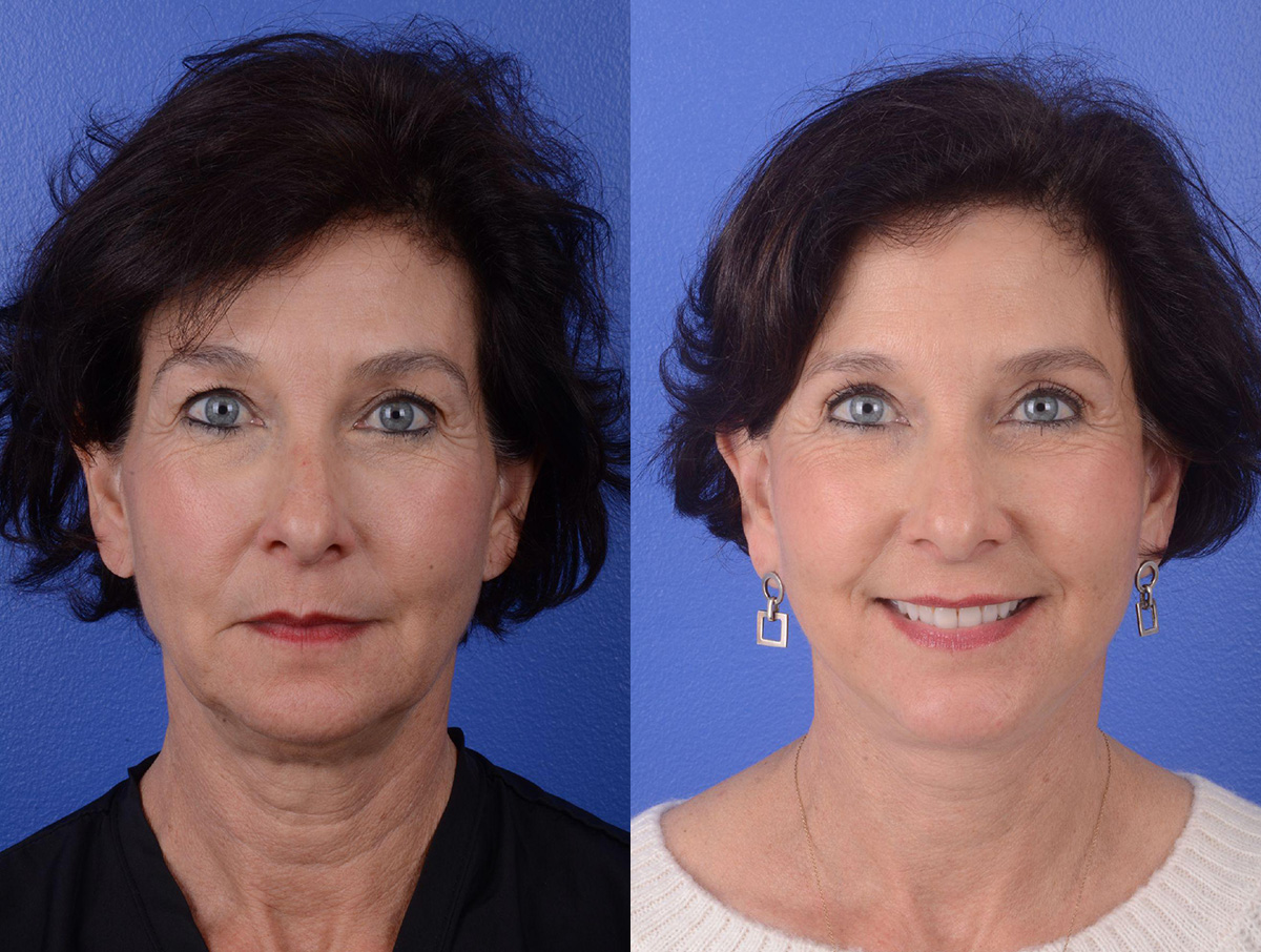 Facelift Before & After Gallery - Patient 319497 - Image 1