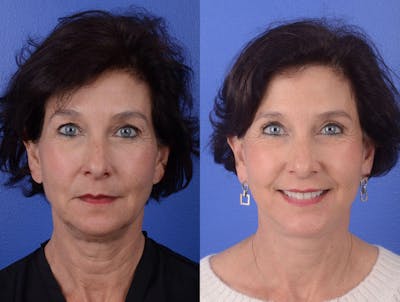 Facelift Before & After Gallery - Patient 319497 - Image 1