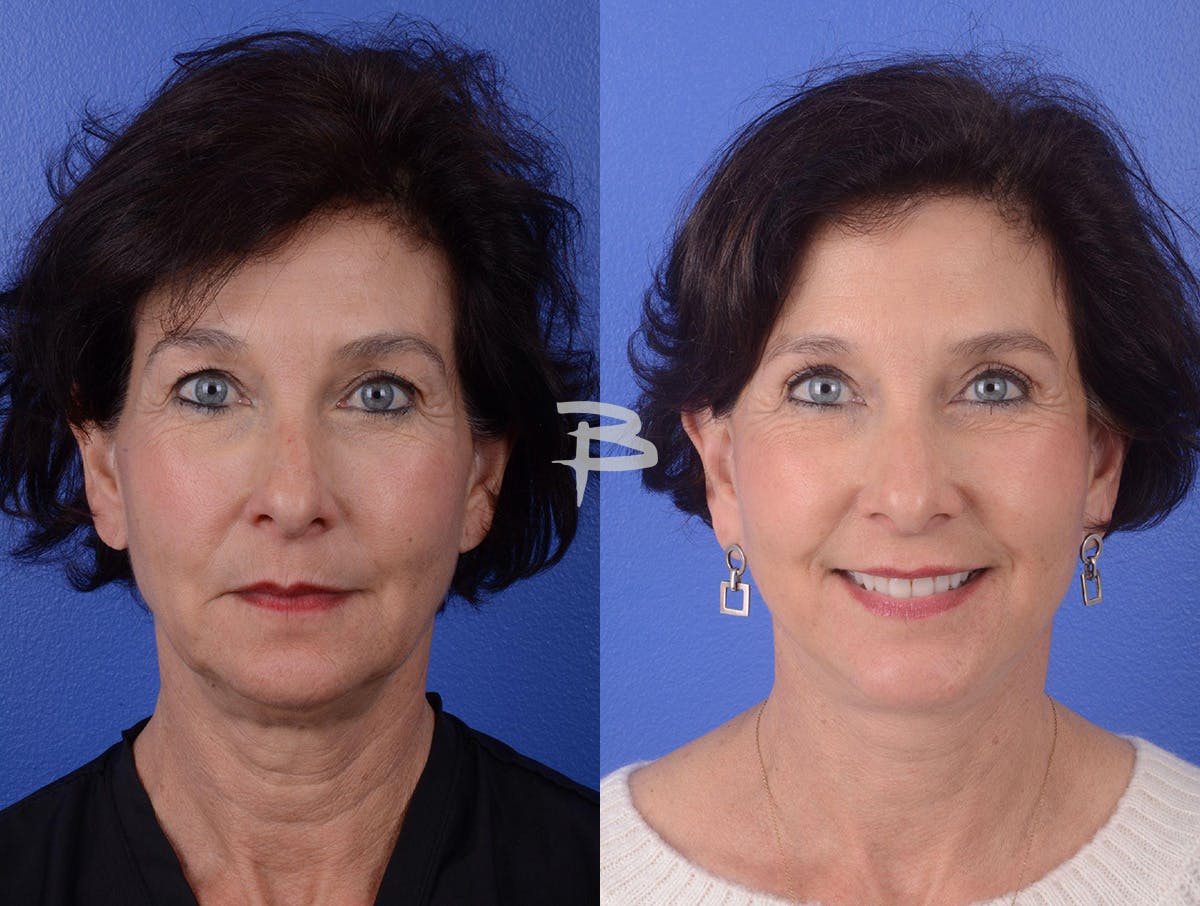 Facelift Before & After Gallery - Patient 319497 - Image 1