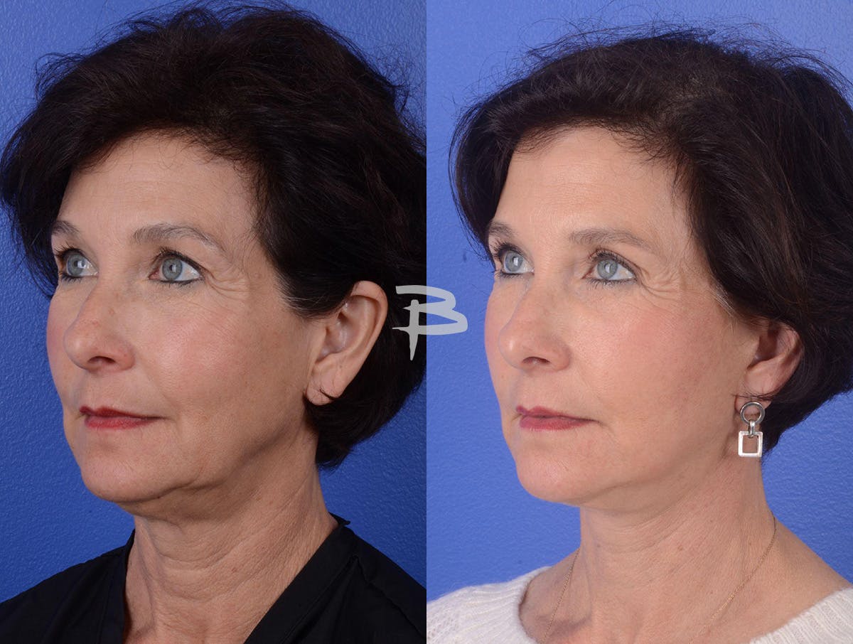 Facelift Before & After Gallery - Patient 319497 - Image 2