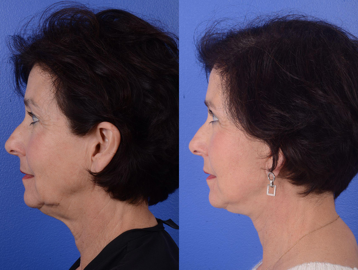 Facelift Before & After Gallery - Patient 319497 - Image 3