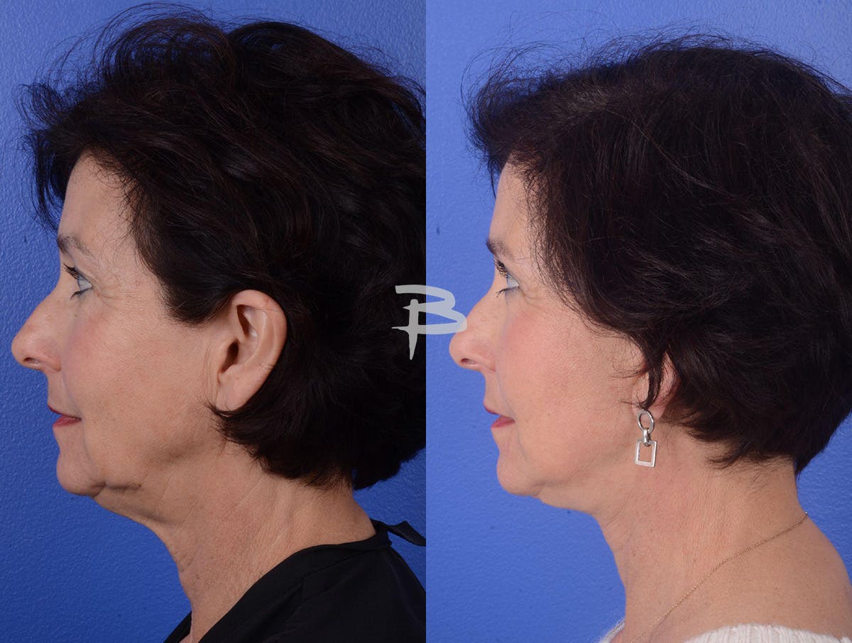 Facelift Before & After Gallery - Patient 319497 - Image 3