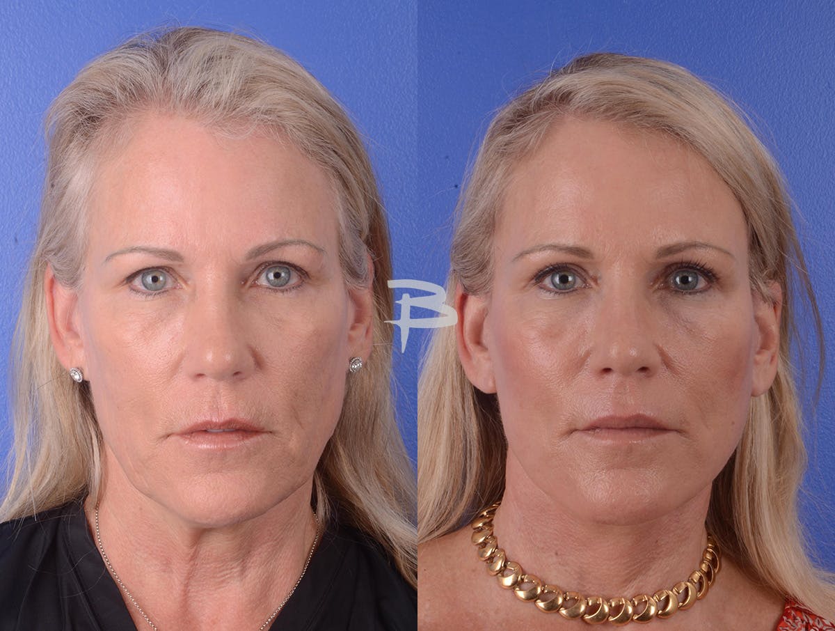 Facelift Before & After Gallery - Patient 351473 - Image 1