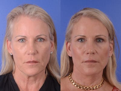 Facelift Before & After Gallery - Patient 351473 - Image 1