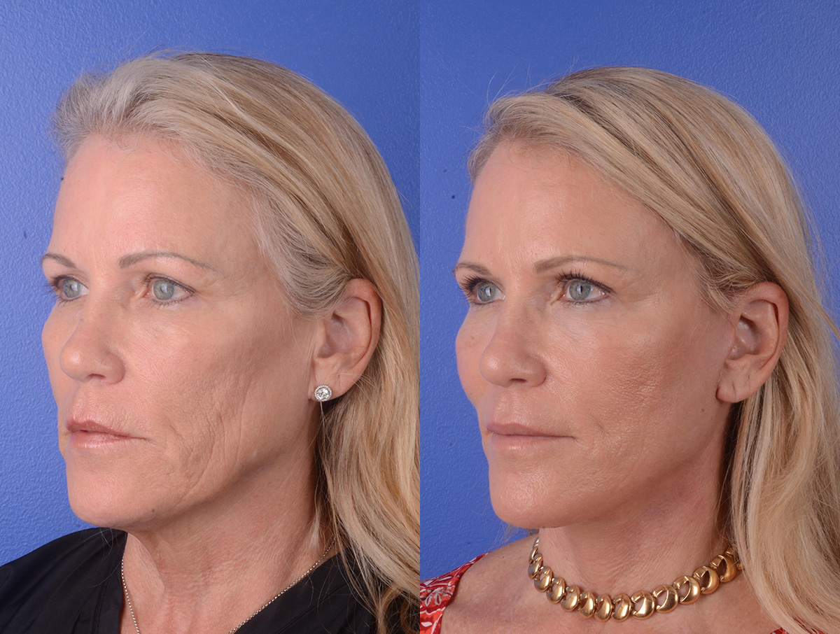 Facelift Before & After Gallery - Patient 351473 - Image 2