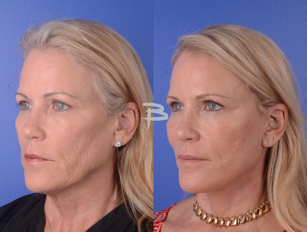 Facelift Before & After Gallery - Patient 351473 - Image 2