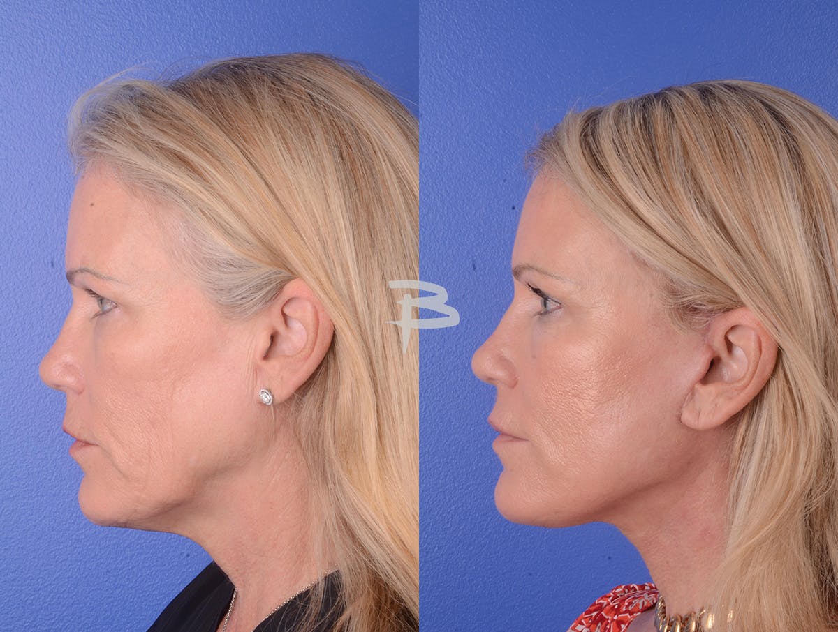 Facelift Before & After Gallery - Patient 351473 - Image 3