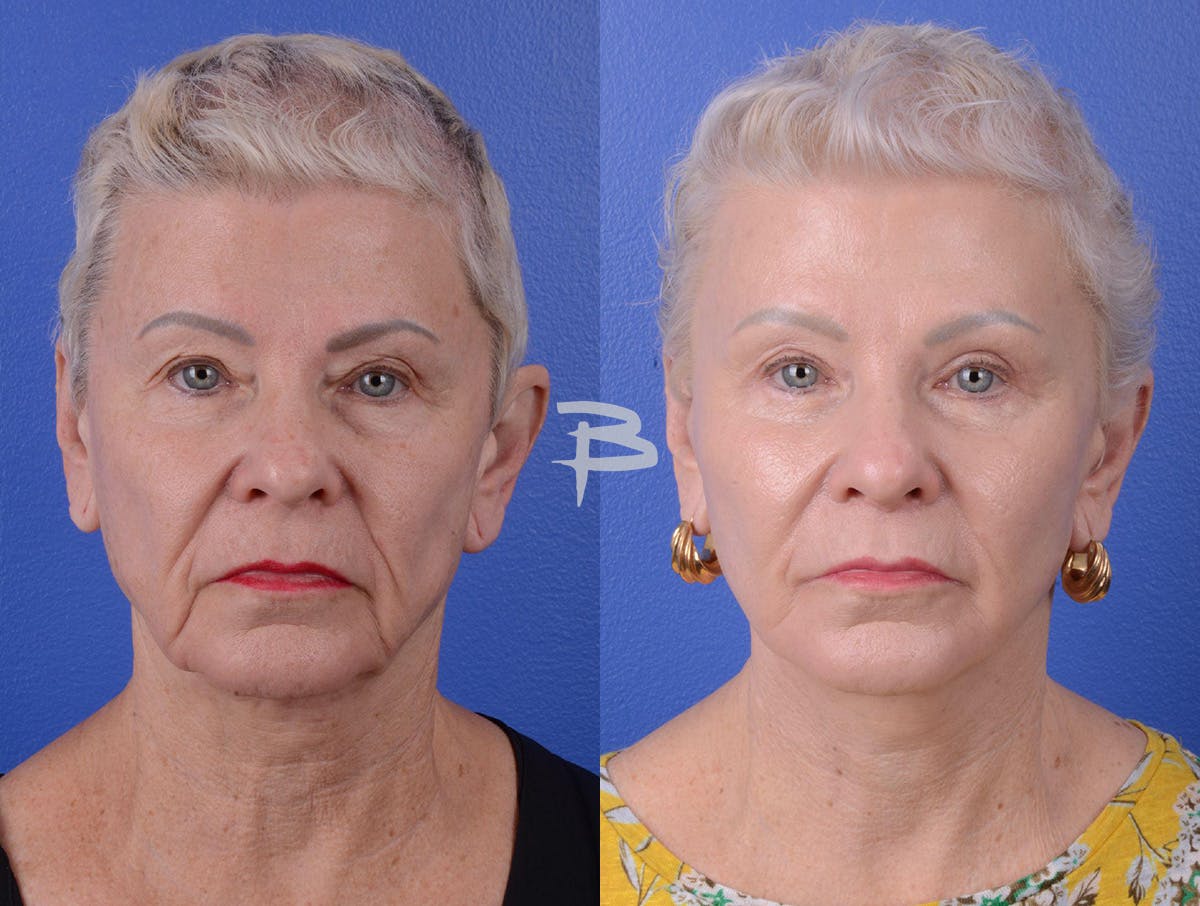Facelift Before & After Gallery - Patient 160163 - Image 1