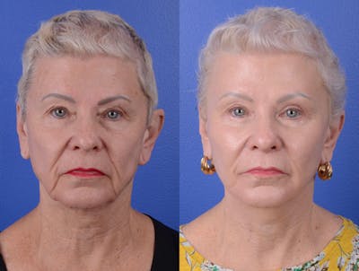 Facelift Before & After Gallery - Patient 160163 - Image 1