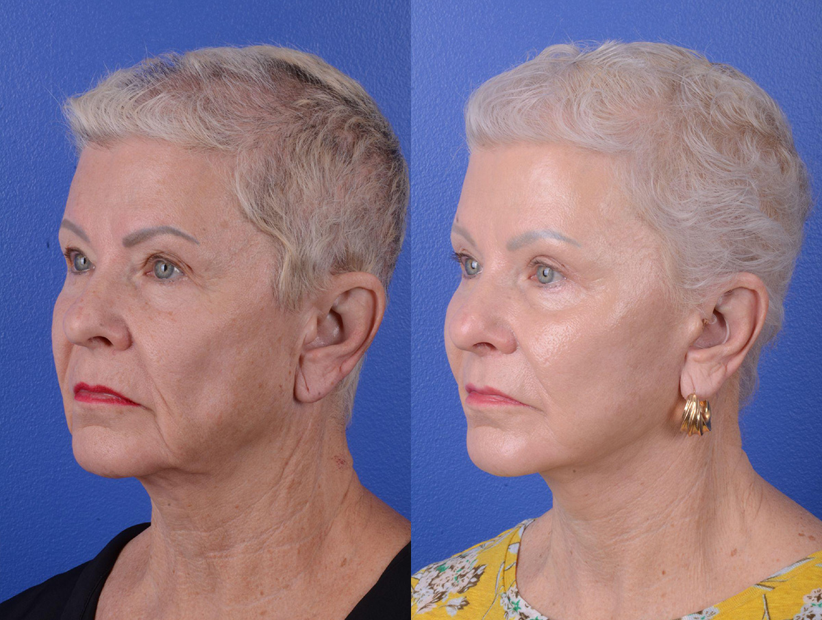 Facelift Before & After Gallery - Patient 160163 - Image 2