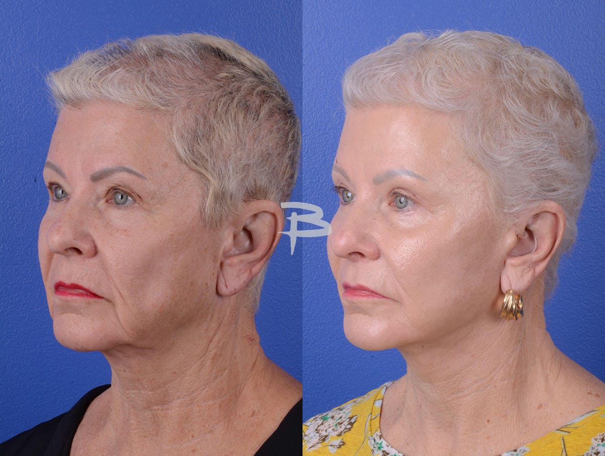 Facelift Before & After Gallery - Patient 160163 - Image 2
