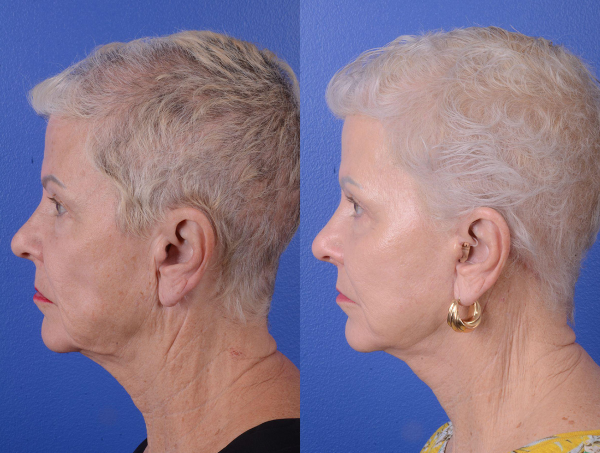 Facelift Before & After Gallery - Patient 160163 - Image 3