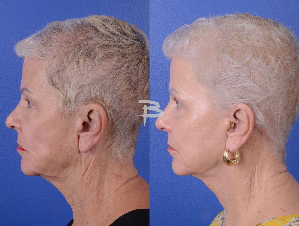 Facelift Before & After Gallery - Patient 160163 - Image 3