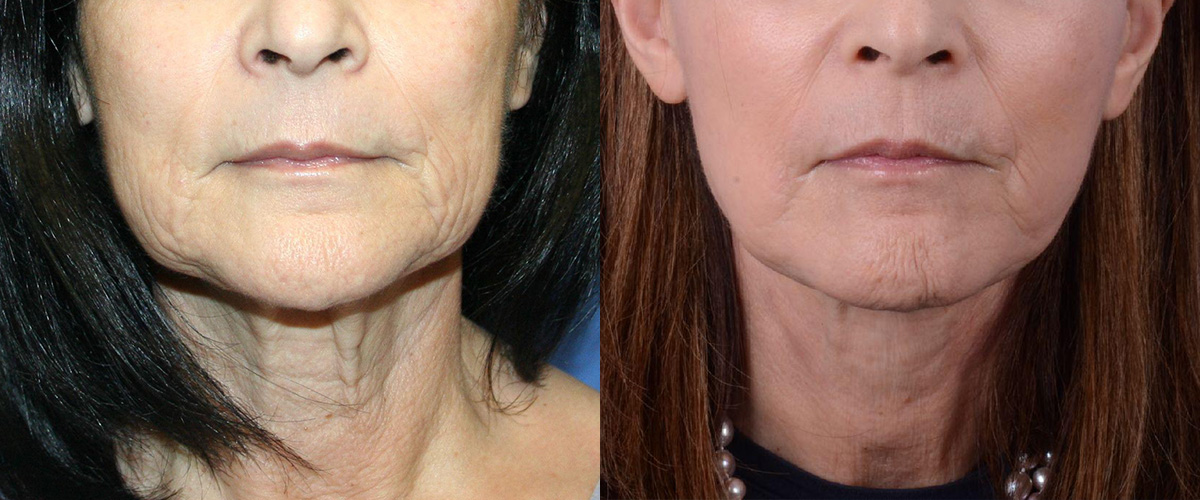 Simplicity Neck Lift Before & After Gallery - Patient 273029 - Image 3