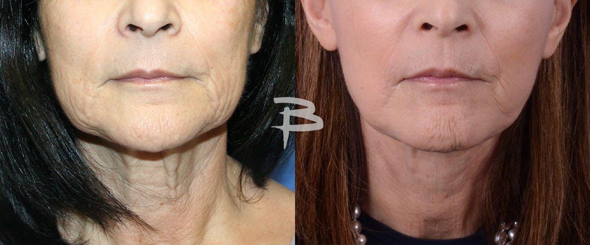Simplicity Neck Lift Before & After Gallery - Patient 273029 - Image 3