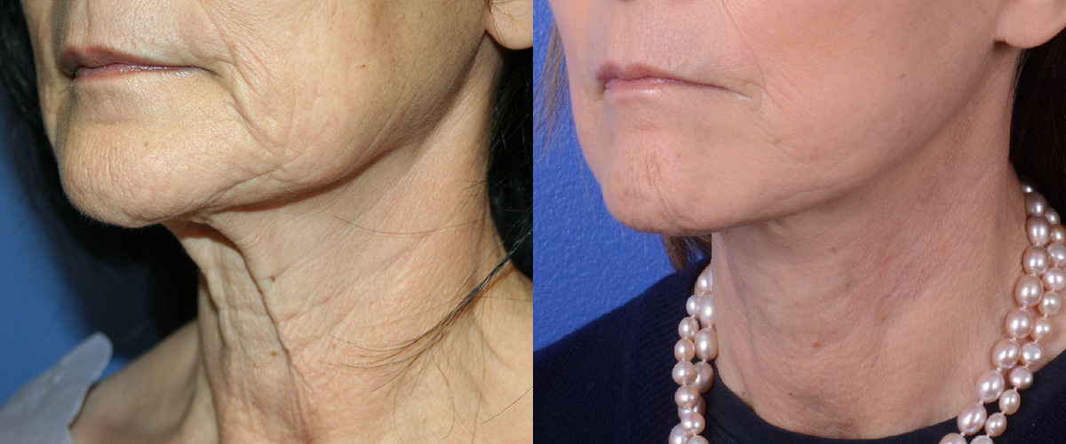 Simplicity Neck Lift Before & After Gallery - Patient 273029 - Image 2