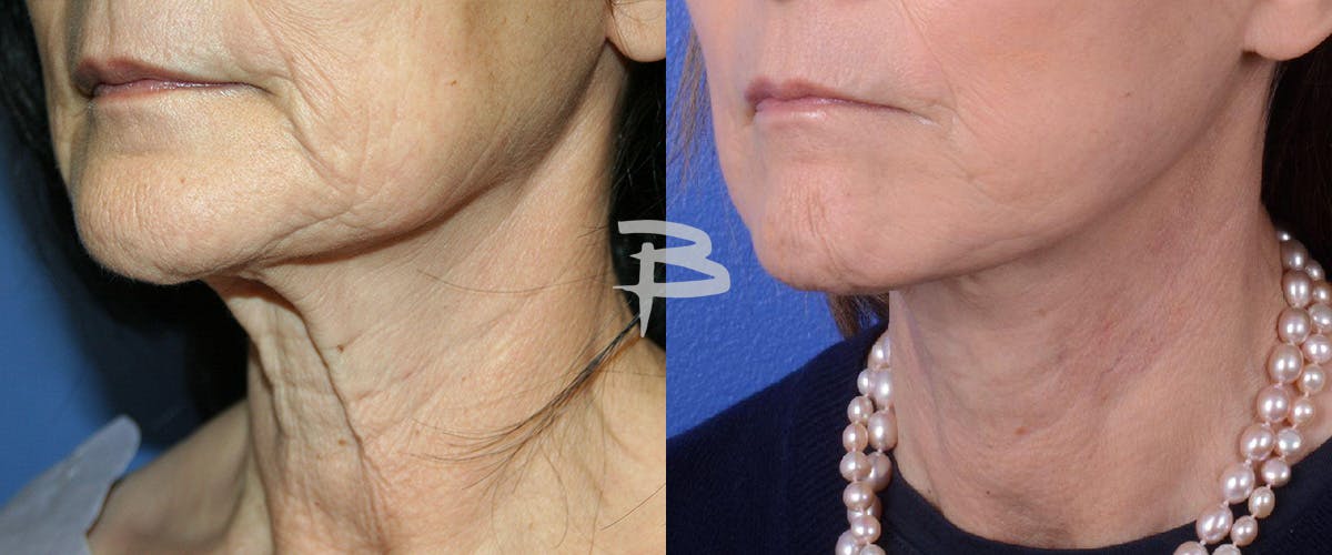 Simplicity Neck Lift Before & After Gallery - Patient 273029 - Image 2