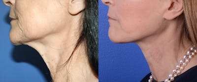 Simplicity Neck Lift Before & After Gallery - Patient 273029 - Image 1