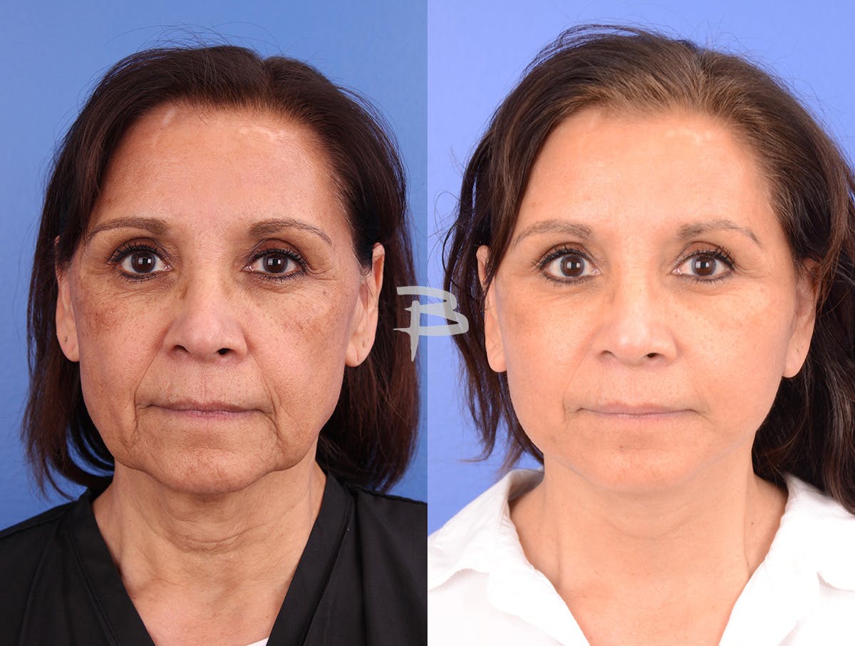 Facelift Before & After Gallery - Patient 120653 - Image 1