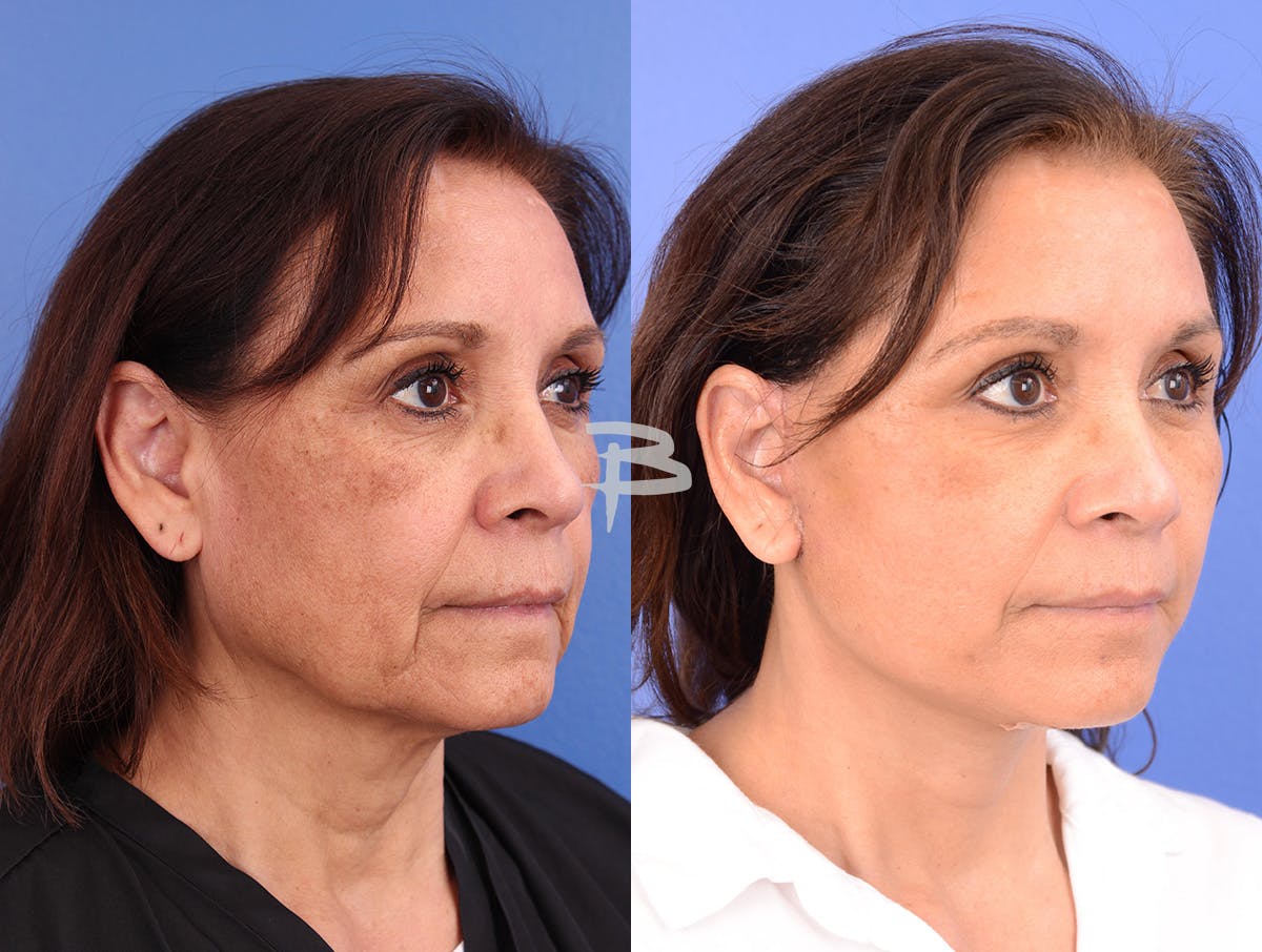 Facelift Before & After Gallery - Patient 120653 - Image 2