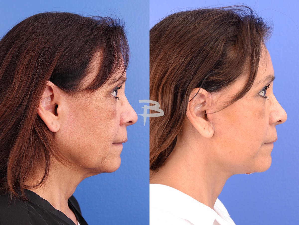 Facelift Before & After Gallery - Patient 120653 - Image 3
