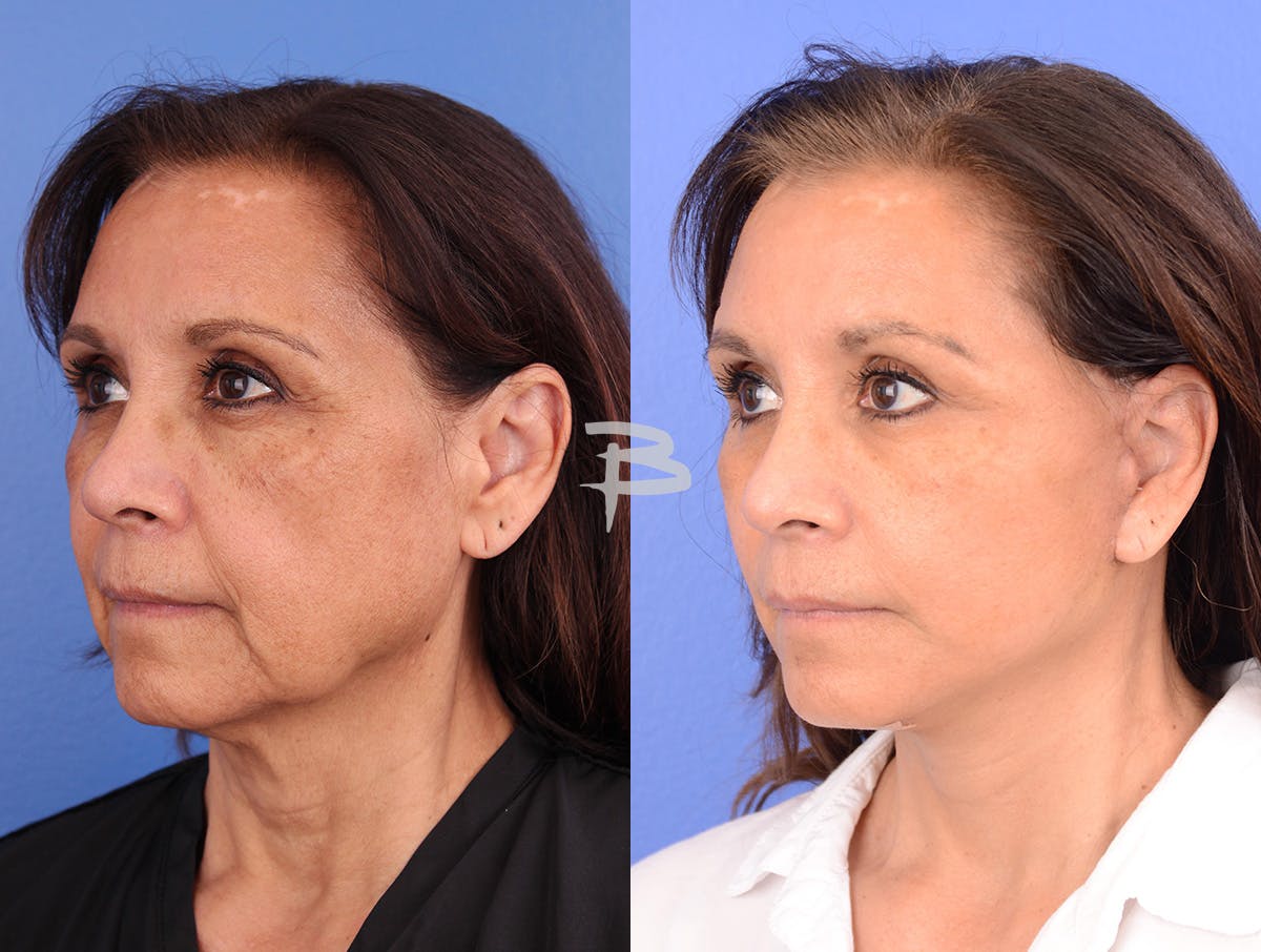 Facelift Before & After Gallery - Patient 120653 - Image 4