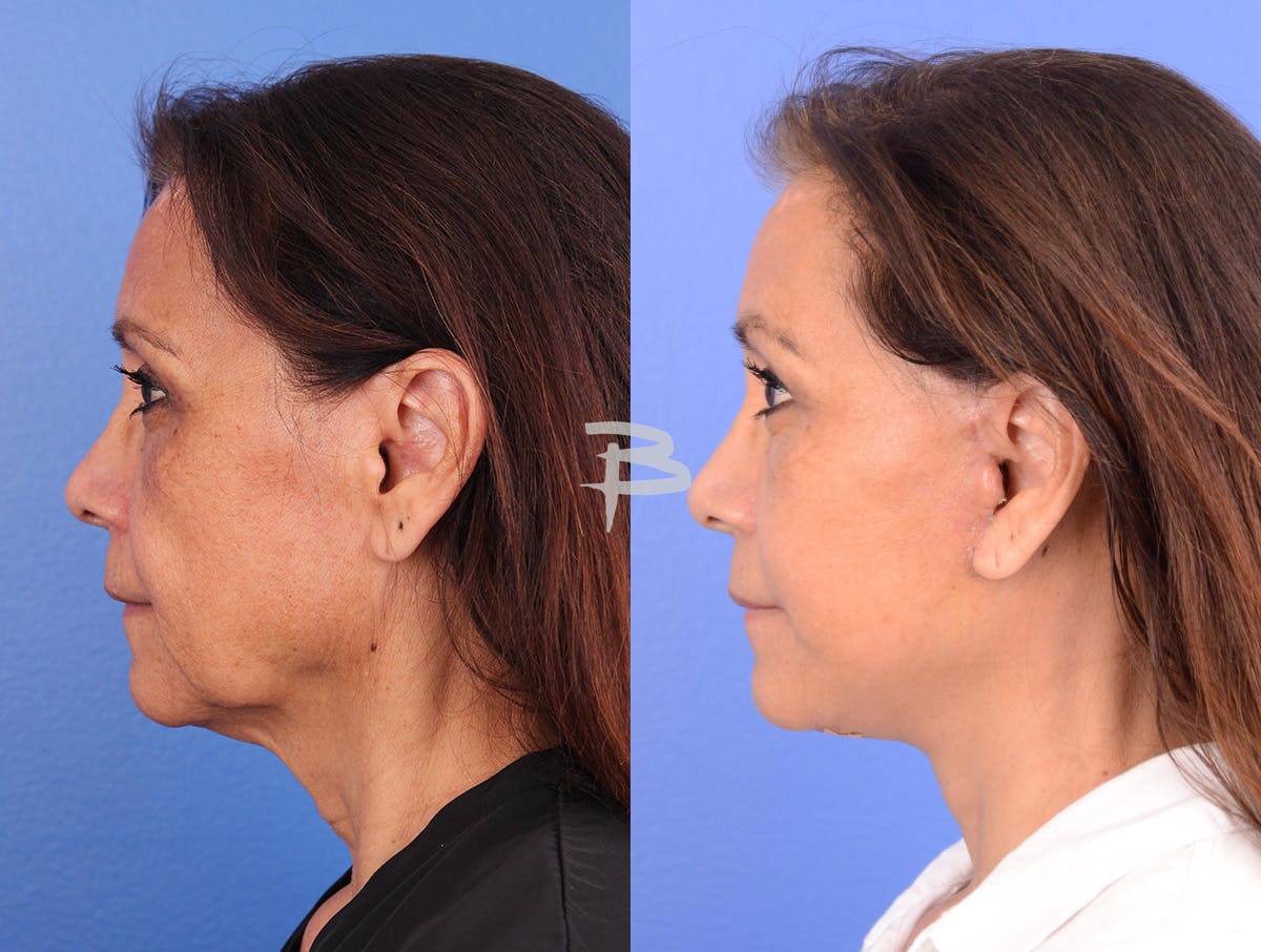 Facelift Before & After Gallery - Patient 120653 - Image 5