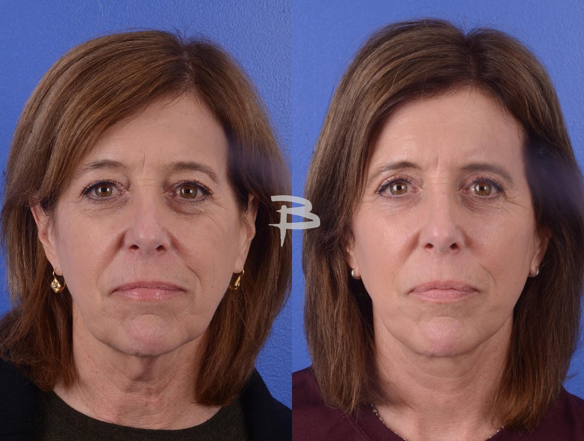 Facelift Before & After Gallery - Patient 207631 - Image 1