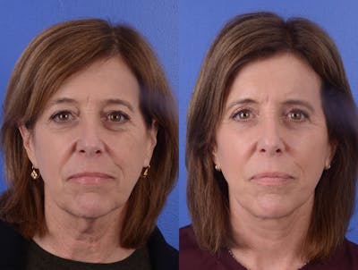Facelift Before & After Gallery - Patient 207631 - Image 1