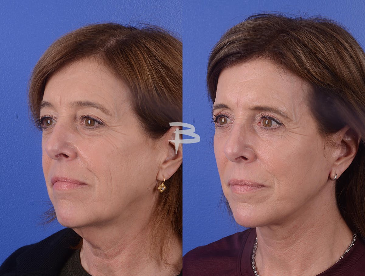 Facelift Before & After Gallery - Patient 207631 - Image 2