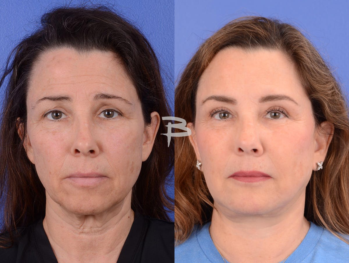 Facelift Before & After Gallery - Patient 134823 - Image 1