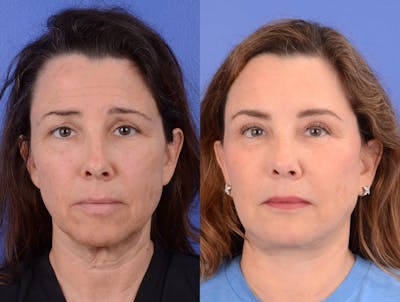 Brow Lift Before & After Gallery - Patient 101162 - Image 1