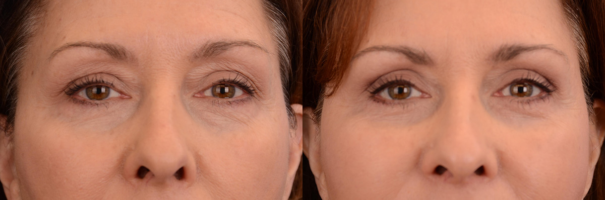 Blepharoplasty Before & After Gallery - Patient 218460 - Image 1
