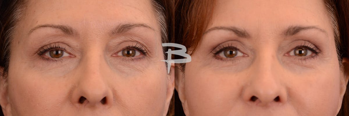 Blepharoplasty Before & After Gallery - Patient 218460 - Image 1