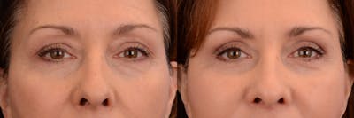 Blepharoplasty Before & After Gallery - Patient 218460 - Image 1