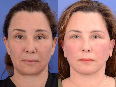 Facelift Before & After Gallery - Patient 296689 - Image 1