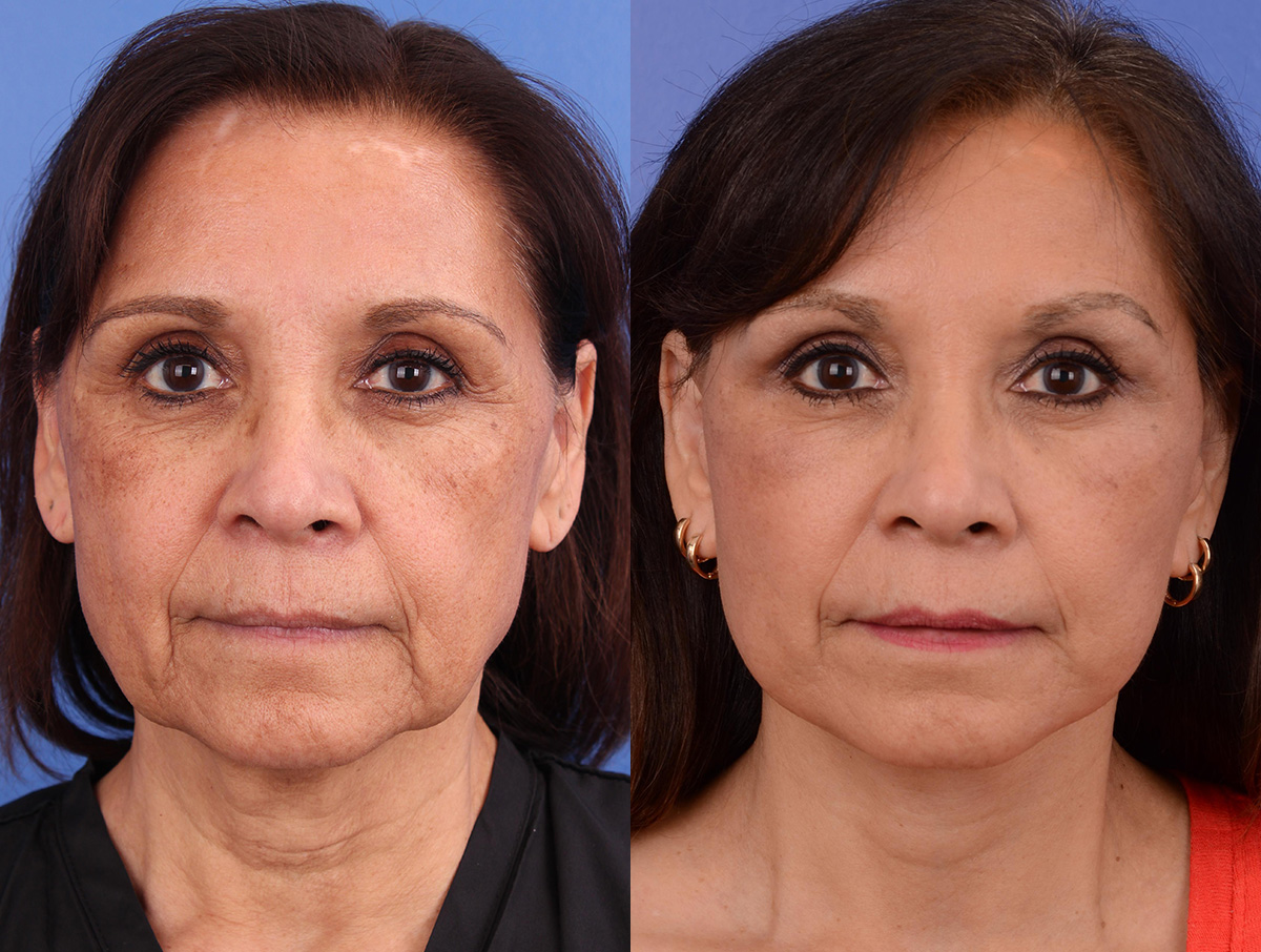Facelift Before & After Gallery - Patient 116051 - Image 1