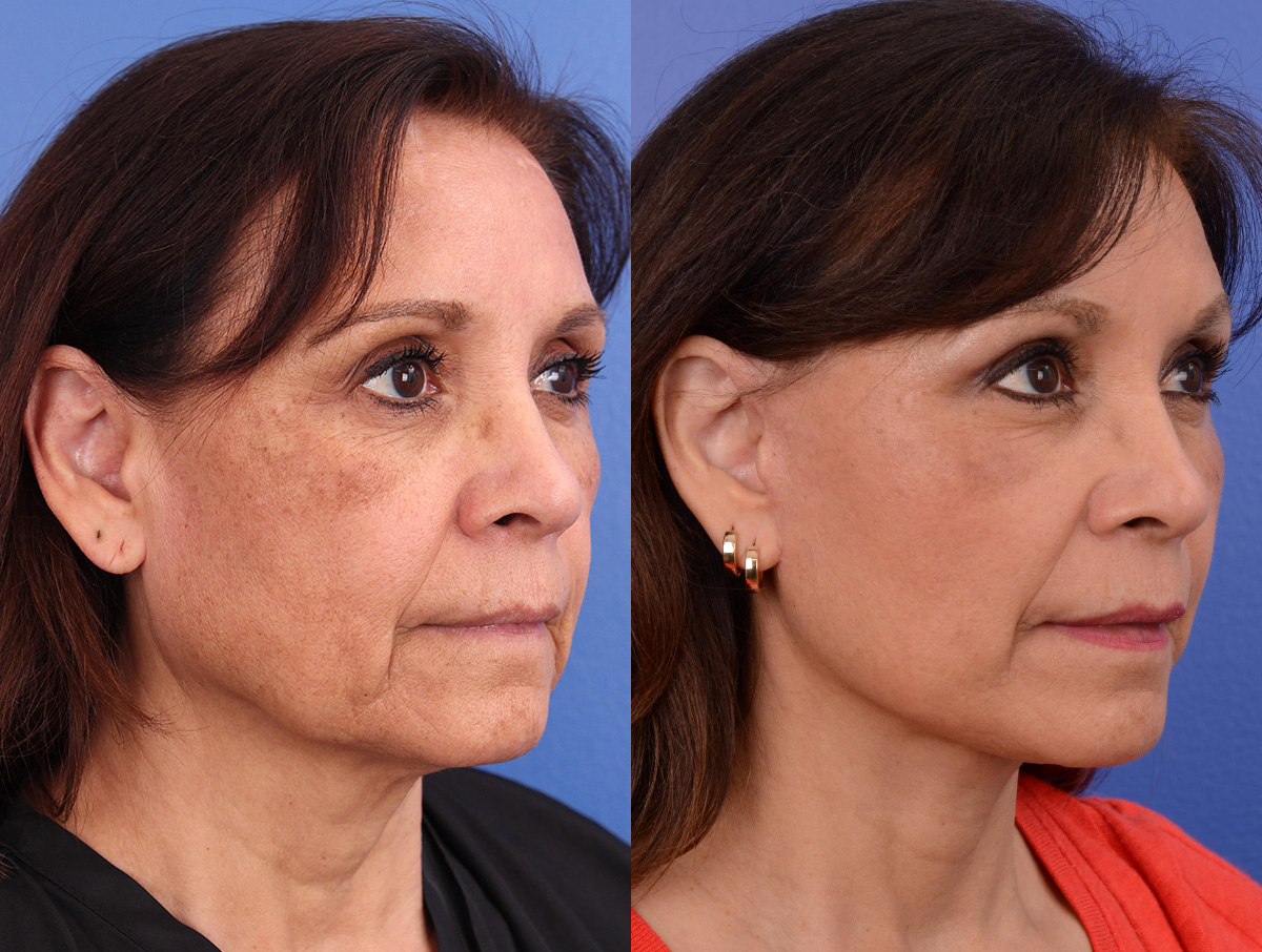 Facelift Before & After Gallery - Patient 116051 - Image 2