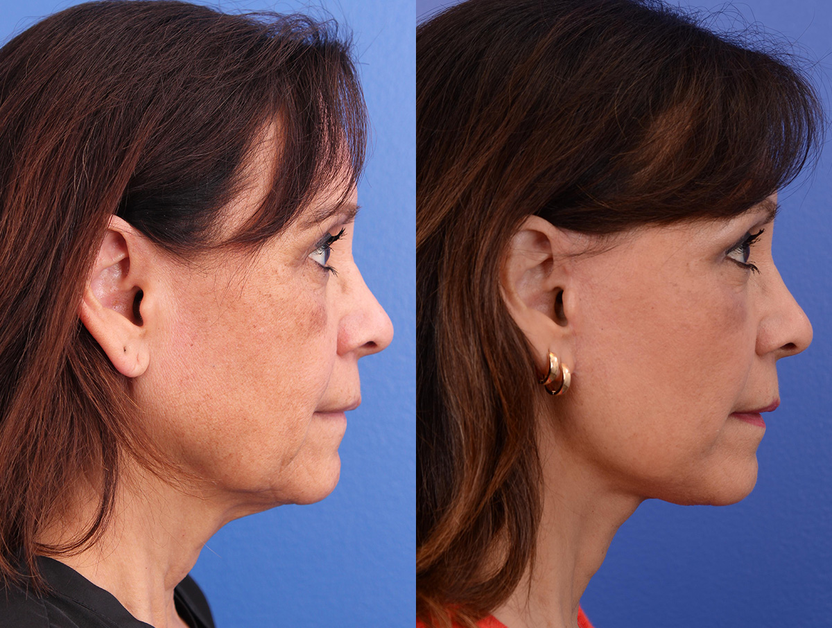 Facelift Before & After Gallery - Patient 116051 - Image 3