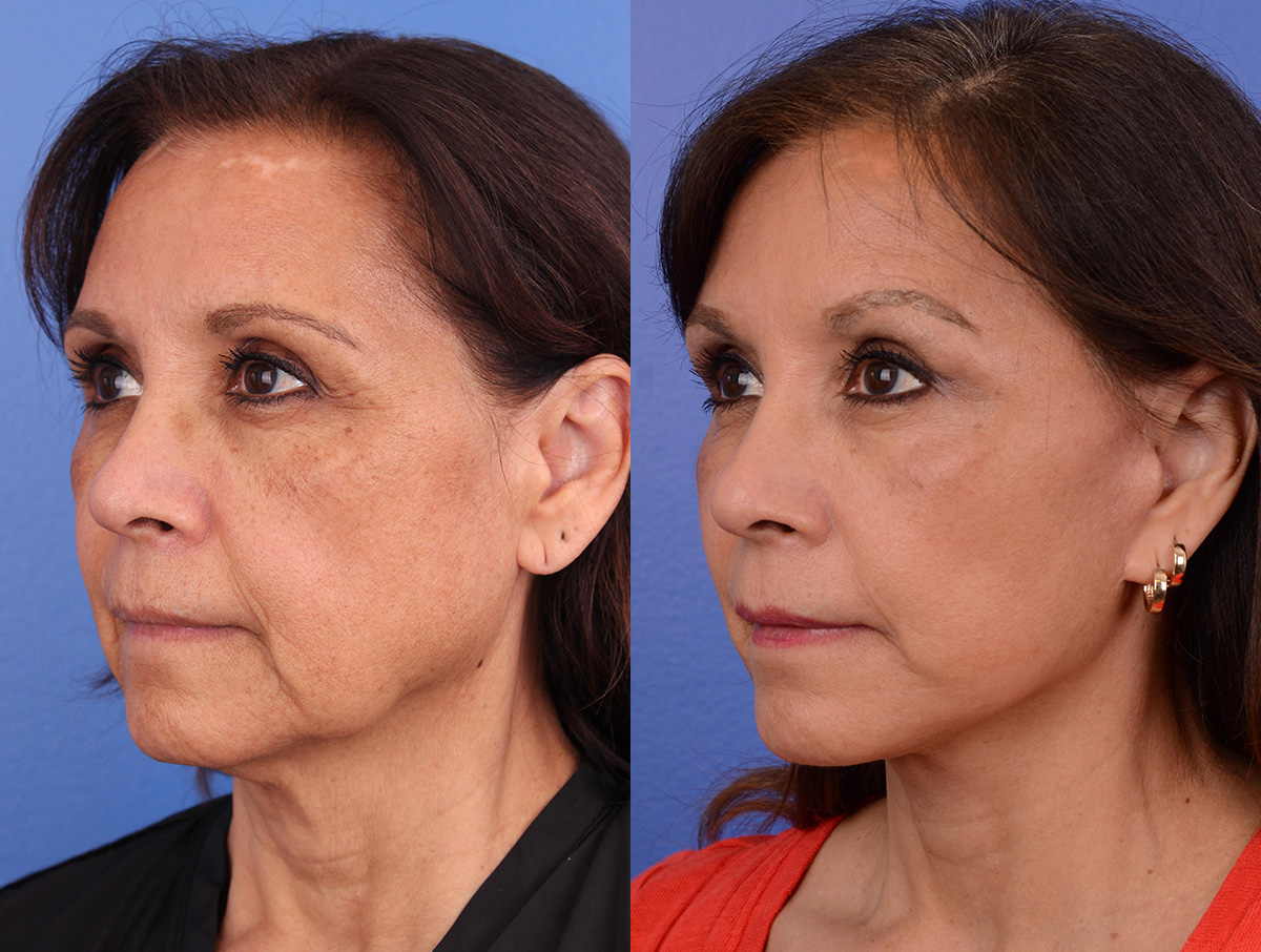 Facelift Before & After Gallery - Patient 116051 - Image 4