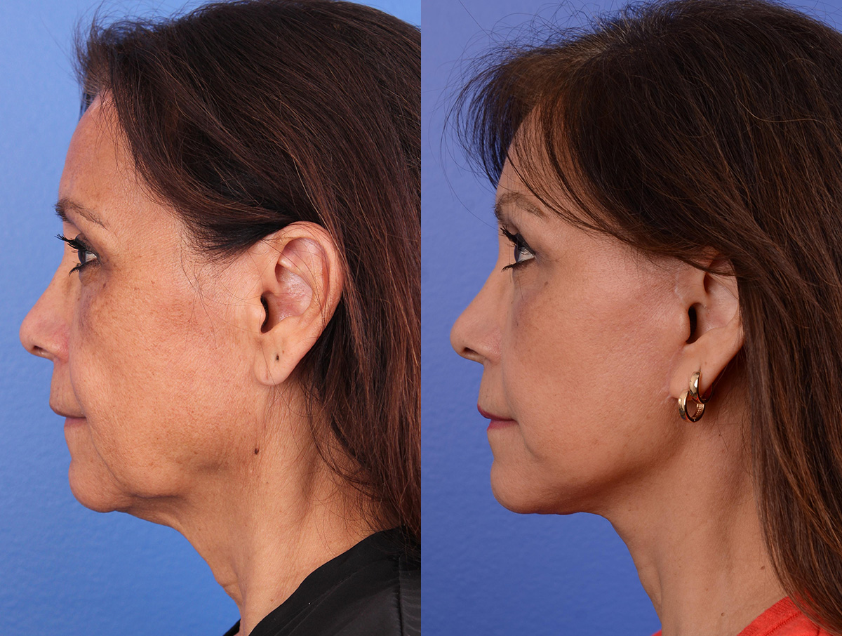 Facelift Before & After Gallery - Patient 116051 - Image 5