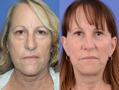 Recovery Before & After Gallery - Patient 392918 - Image 1