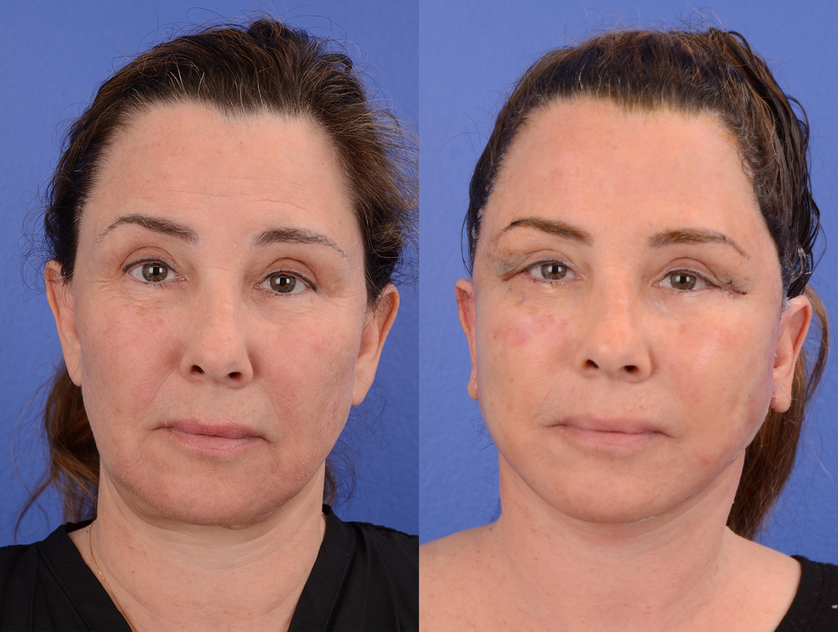 Recovery Before & After Gallery - Patient 256704 - Image 1