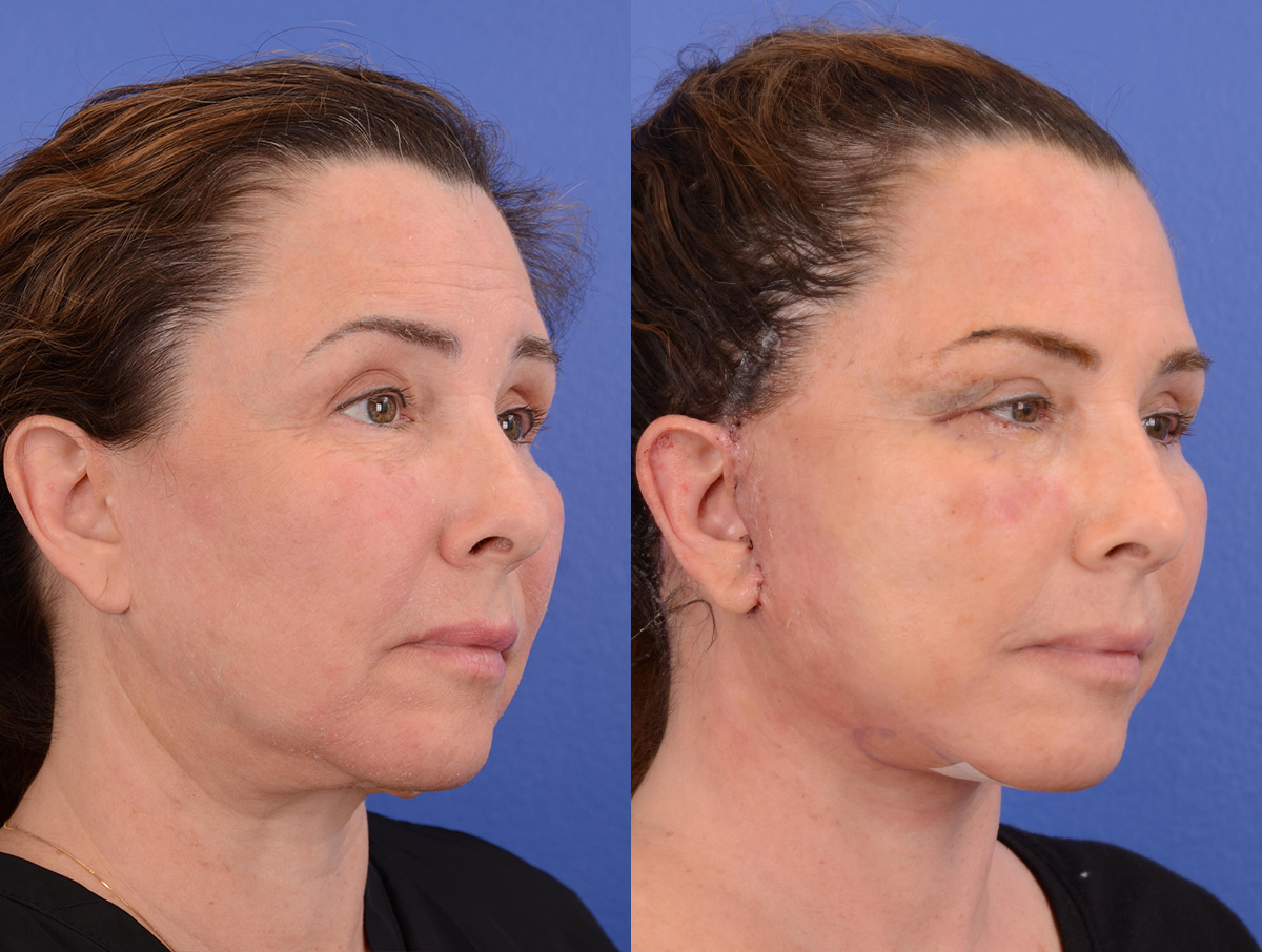 Recovery Before & After Gallery - Patient 256704 - Image 2